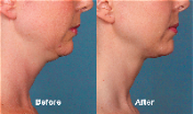 Kybella for Chin side view