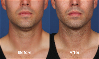 Kybella dissolves the fat and contract the fullness under the chin