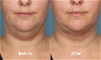 Kybella therapy for double chin